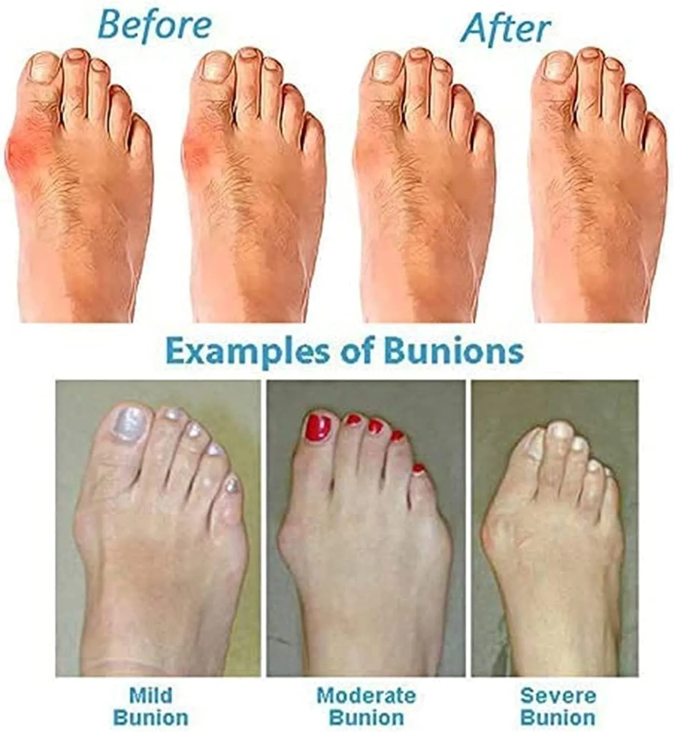 Non-Slip Bunion Corrector Sandals Men, Soft Cushion Walking Men's Sandals Bunion Relief